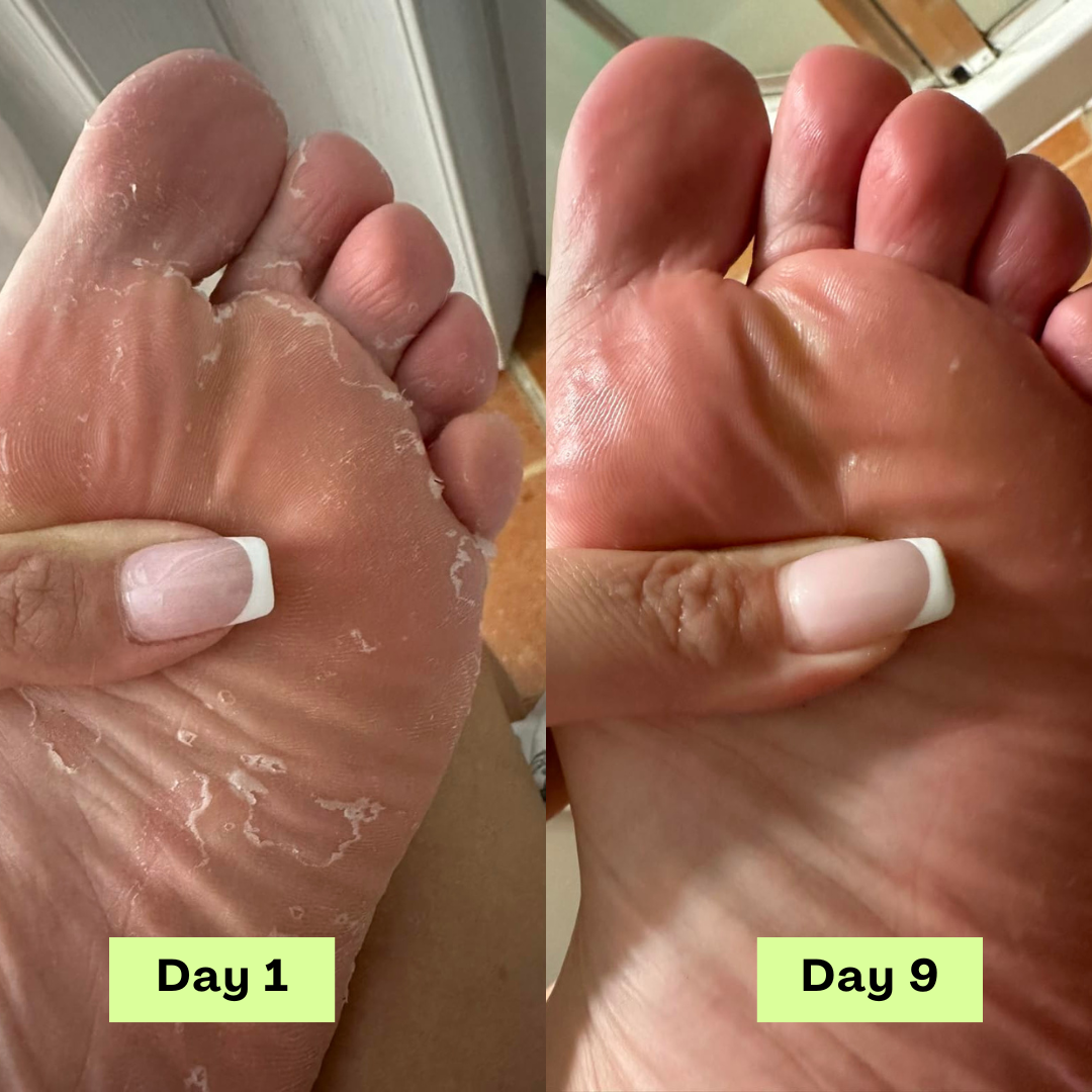 Savon antifongique Nuresty