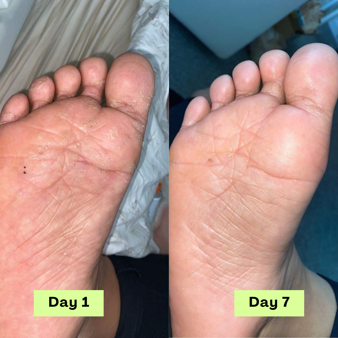 Savon antifongique Nuresty