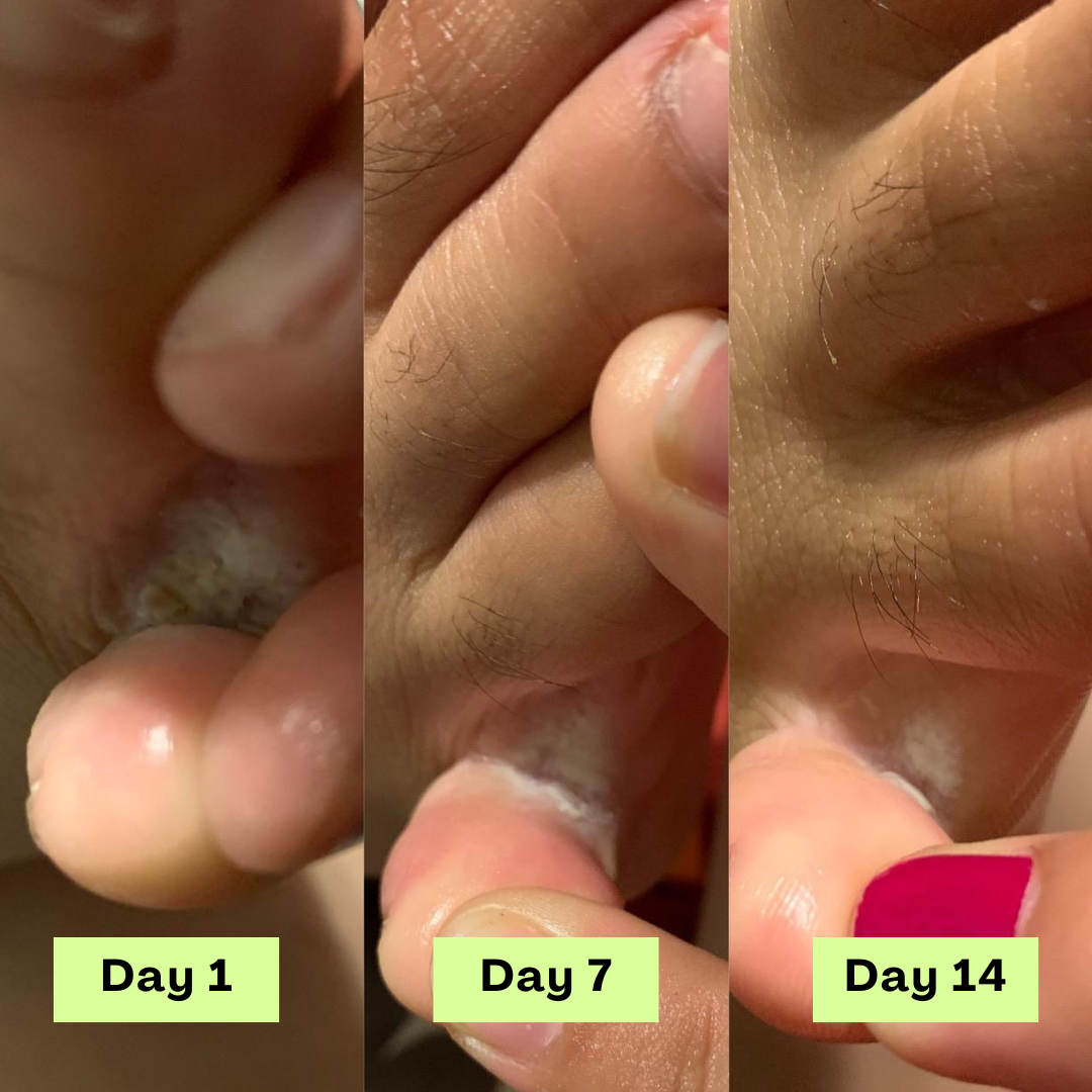 Savon antifongique Nuresty